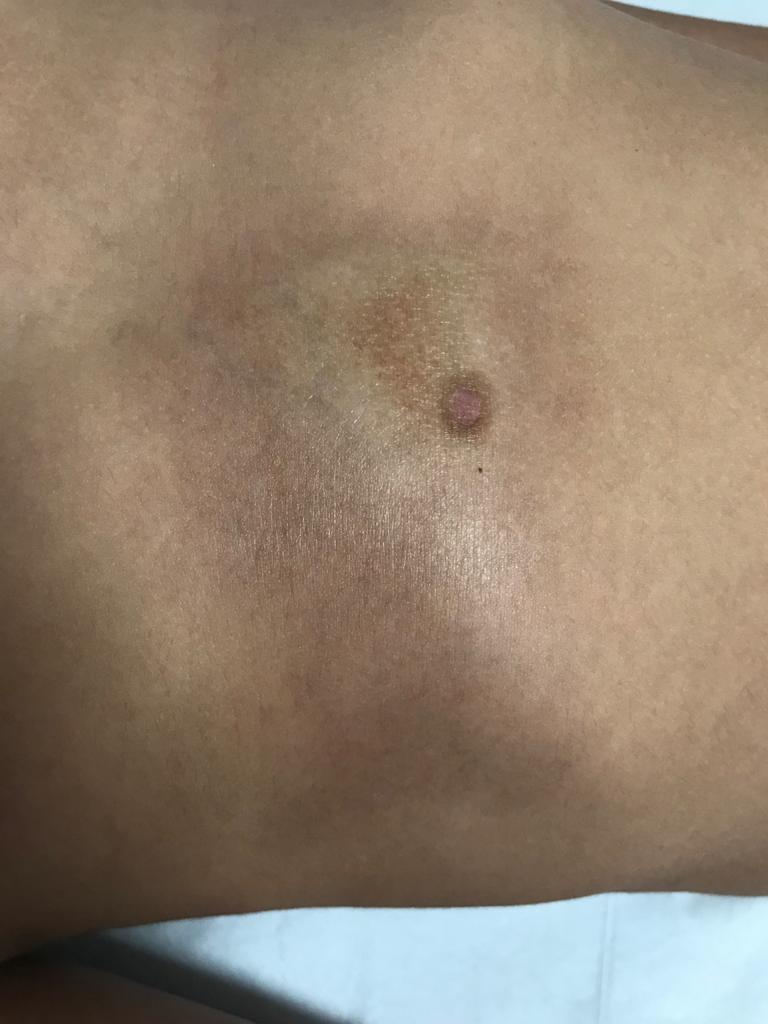 Tratamento de Esclerodermia