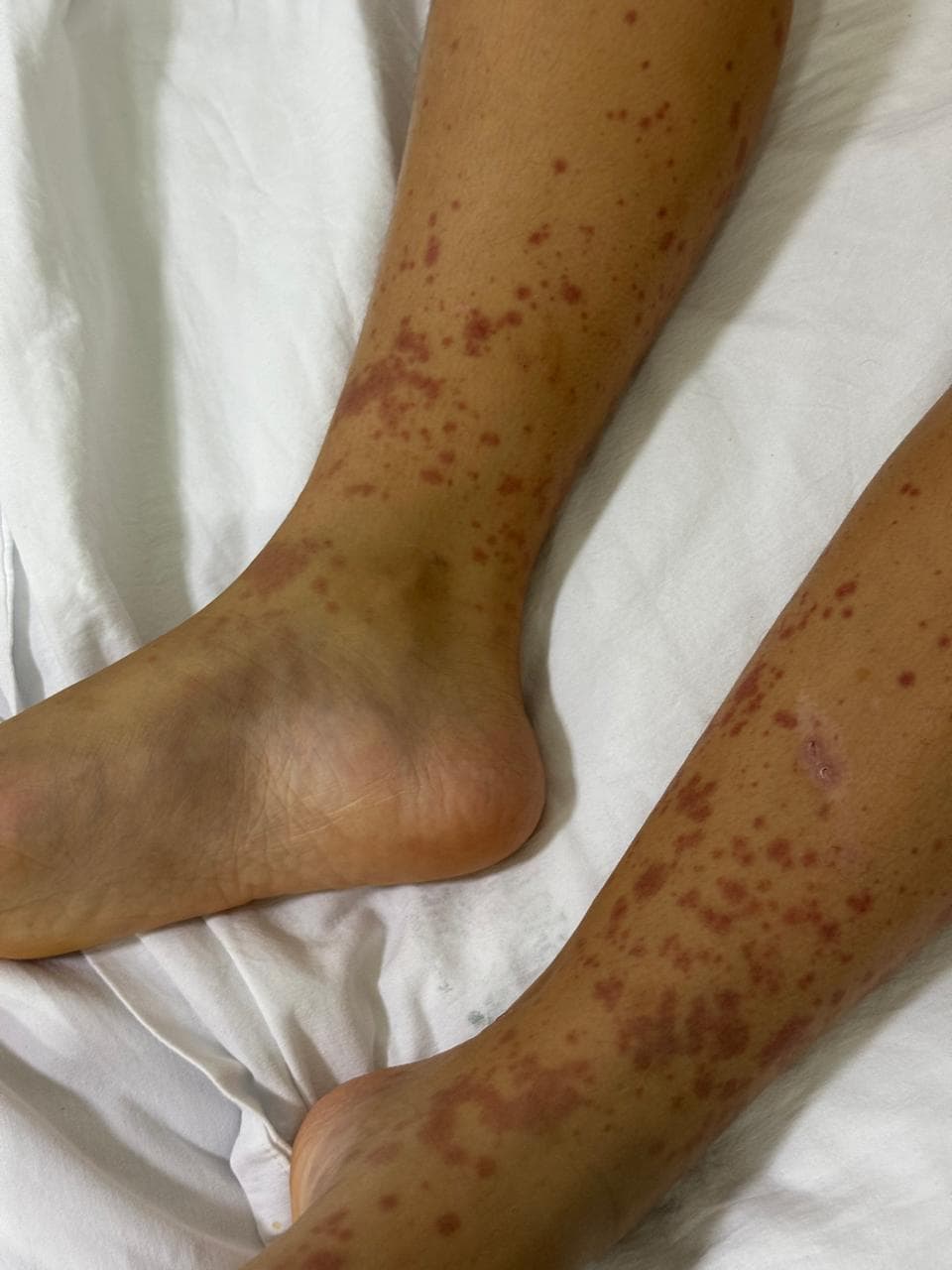 Tratamento de Vasculites na Infância